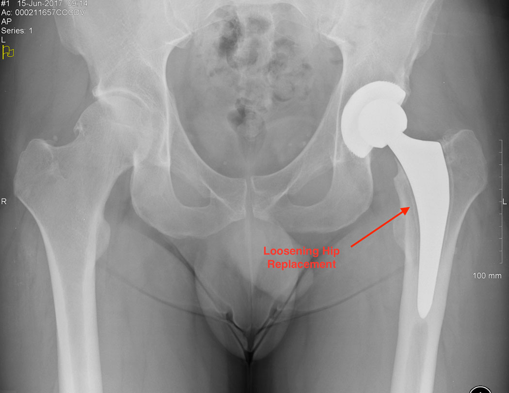 Hip replacement: Symptoms of a bad hip