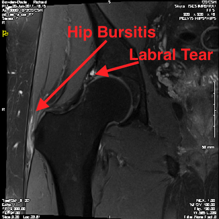 Trochanteric Bursitis – Knee and Hip Website