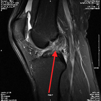 Knee Ligament Injuries – Knee and Hip Website