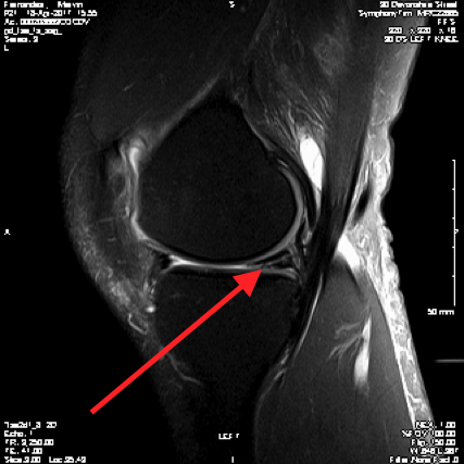 Meniscal Tear Knee Mri